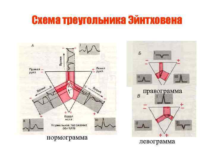 Схема треугольника Эйнтховена правограмма нормограмма левограмма 