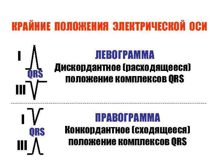 КРАЙНИЕ ПОЛОЖЕНИЯ ЭЛЕКТРИЧЕСКОЙ ОСИ ЛЕВОГРАММА I QRS III I III Дискордантное (расходящееся) положение комплексов