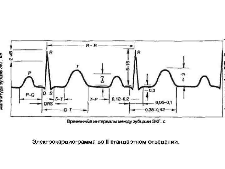 Электрокардиограмма во II стандартном отведении. 