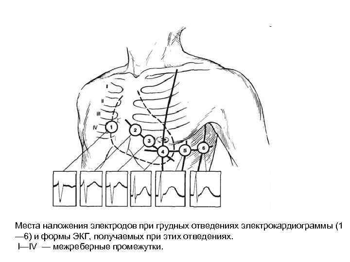 Места наложения электродов при грудных отведениях электрокардиограммы (1 — 6) и формы ЭКГ, получаемых
