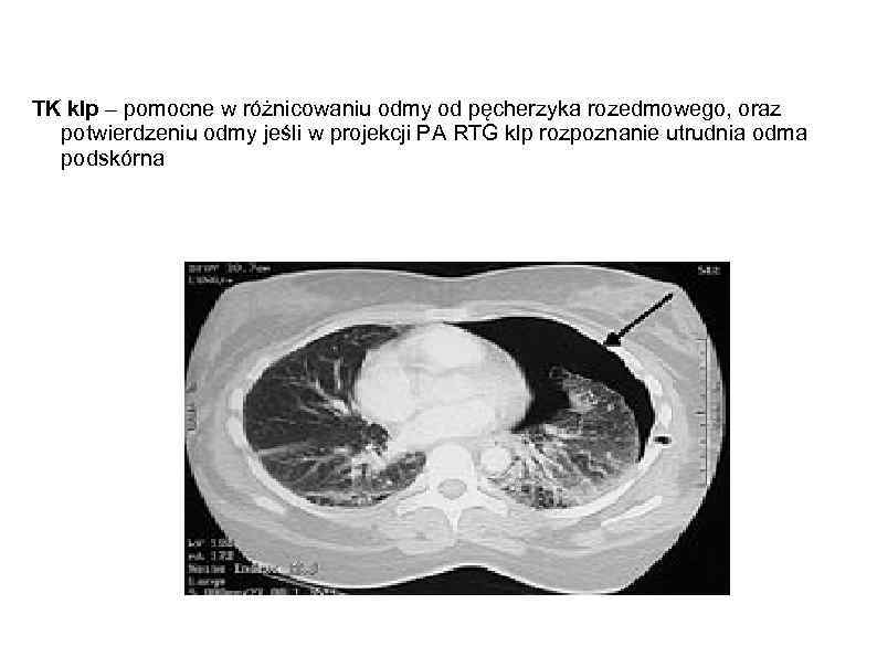 TK klp – pomocne w różnicowaniu odmy od pęcherzyka rozedmowego, oraz potwierdzeniu odmy jeśli