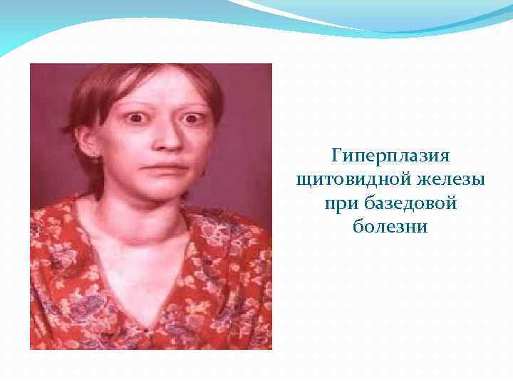 Гиперплазия щитовидной железы при базедовой болезни 