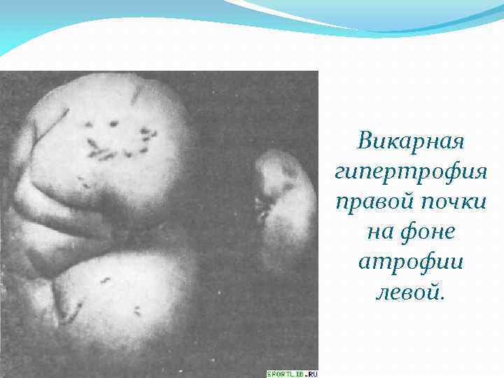 Викарная гипертрофия правой почки на фоне атрофии левой. 