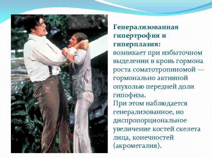 Генерализованная гипертрофия и гиперплазия: возникает при избыточном выделении в кровь гормона роста соматотропиномой —