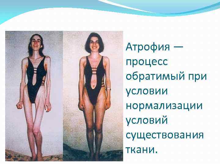 Атрофия — процесс обратимый при условии нормализации условий существования ткани. 