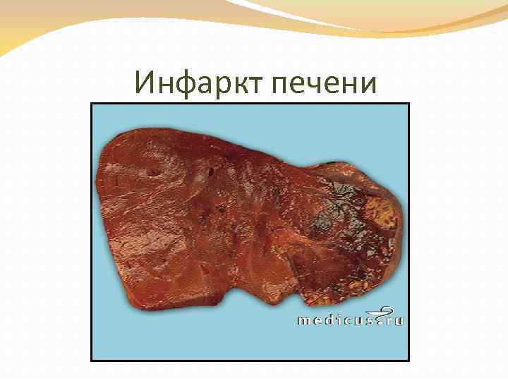 Инфаркт печени 