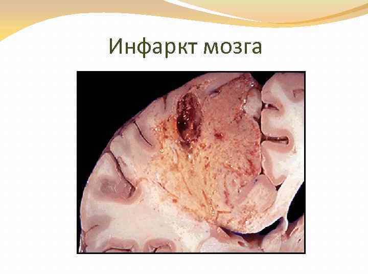 Инфаркт мозга 