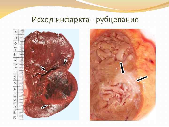 Исход инфаркта - рубцевание 