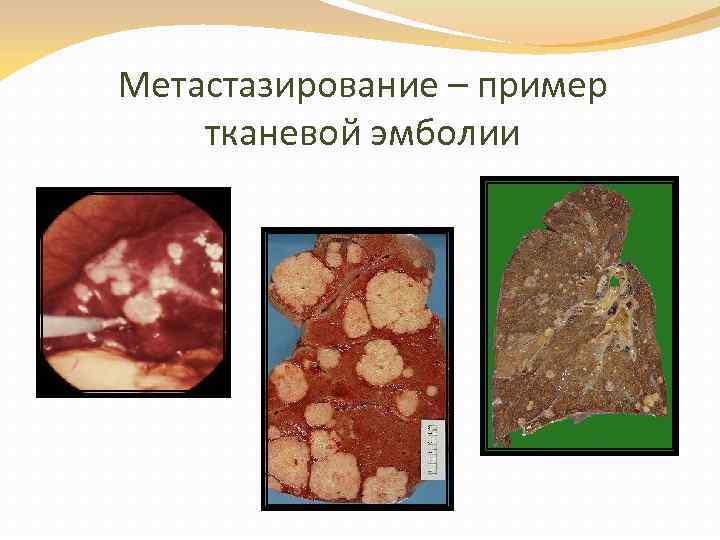 Метастазирование – пример тканевой эмболии 