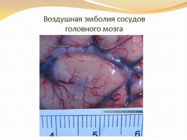 Воздушная эмболия сосудов головного мозга 