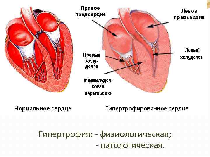 Гипертрофия: - физиологическая; - патологическая. 