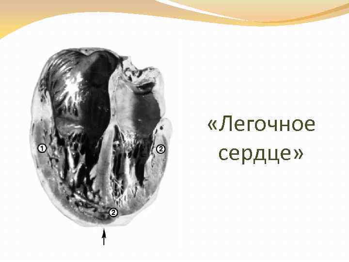  «Легочное сердце» 