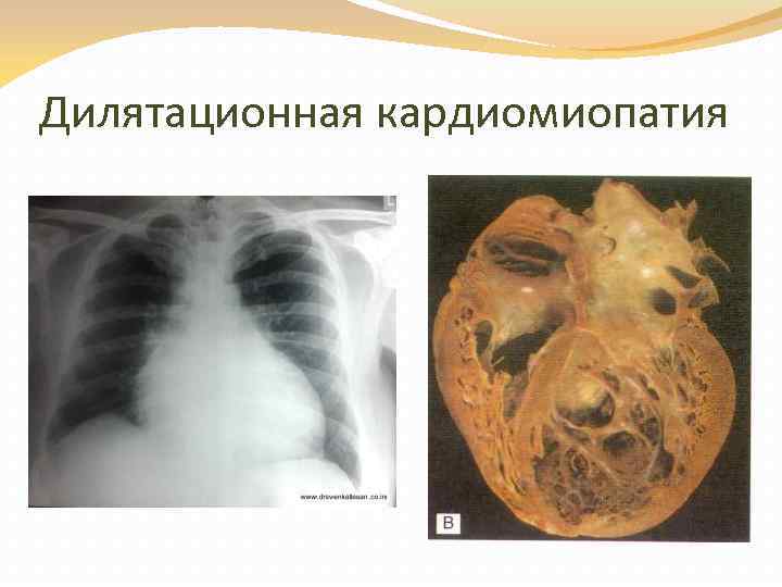 Дилятационная кардиомиопатия 