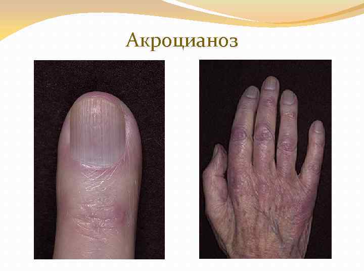 Акроцианоз 