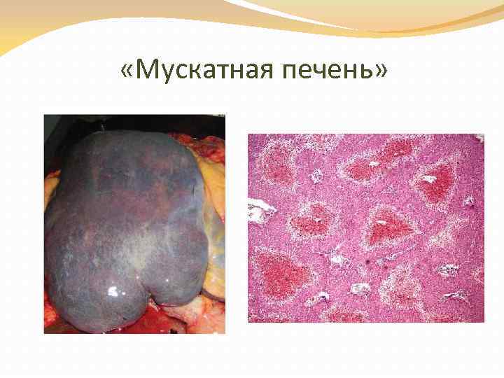 «Мускатная печень» 