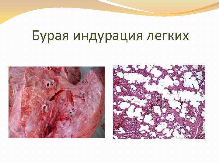 Бурая индурация легких 