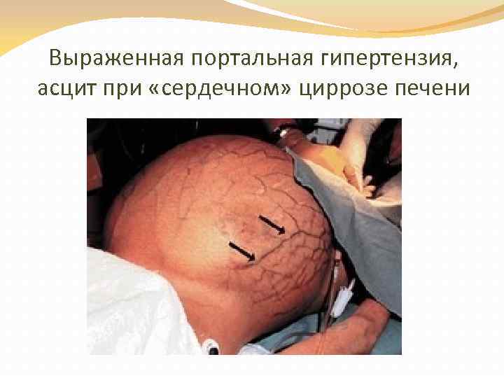 Выраженная портальная гипертензия, асцит при «сердечном» циррозе печени 