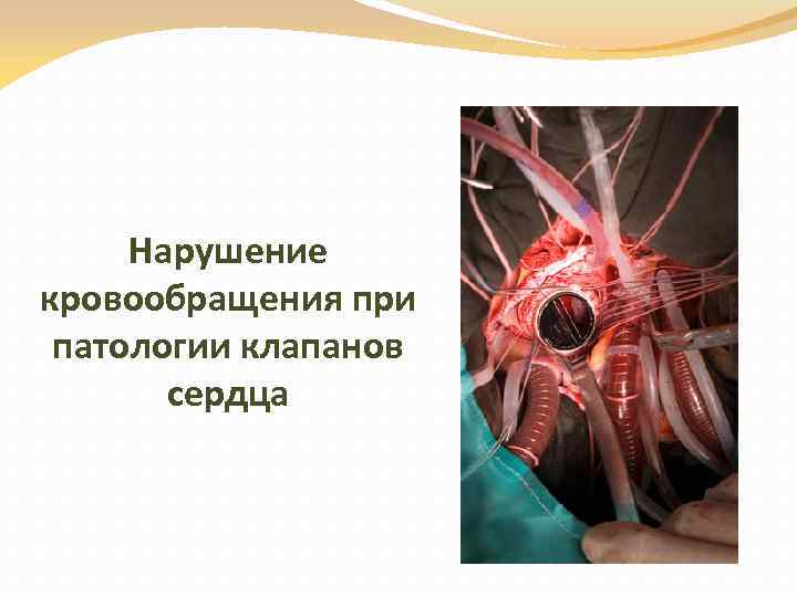Нарушение кровообращения при патологии клапанов сердца 