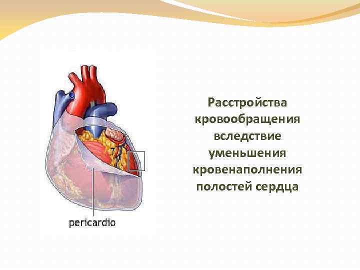 Расстройства кровообращения вследствие уменьшения кровенаполнения полостей сердца 