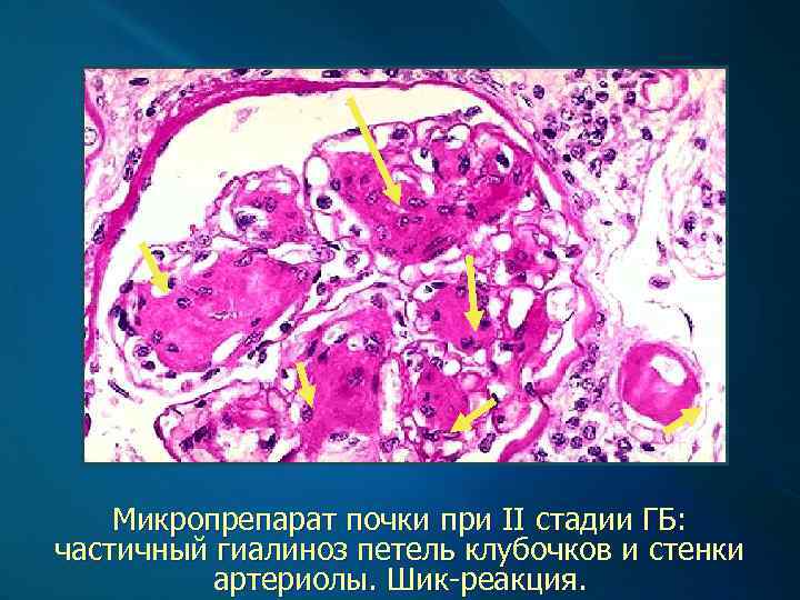 Микропрепарат почки при II стадии ГБ: частичный гиалиноз петель клубочков и стенки артериолы. Шик-реакция.