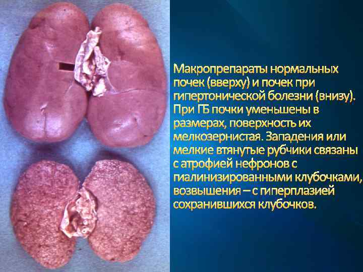 Макропрепараты нормальных почек (вверху) и почек при гипертонической болезни (внизу). При ГБ почки уменьшены