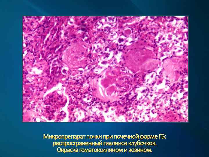 Микропрепарат почки при почечной форме ГБ: распространенный гиалиноз клубочков. Окраска гематоксилином и эозином. 