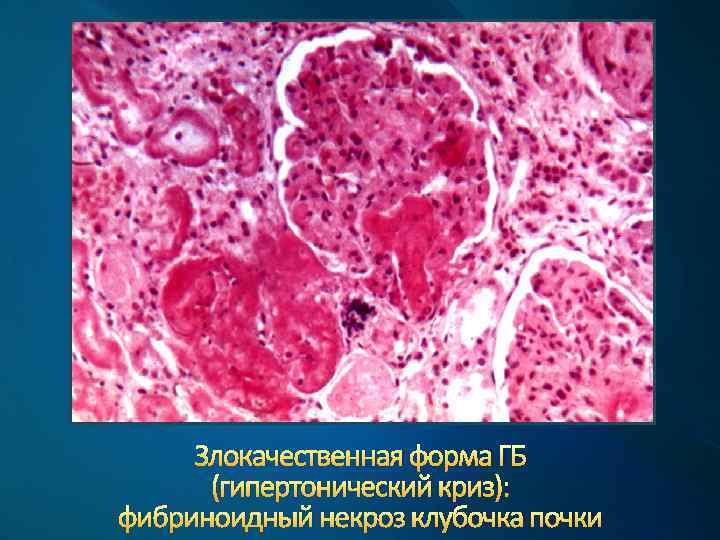 Злокачественная форма ГБ (гипертонический криз): фибриноидный некроз клубочка почки 