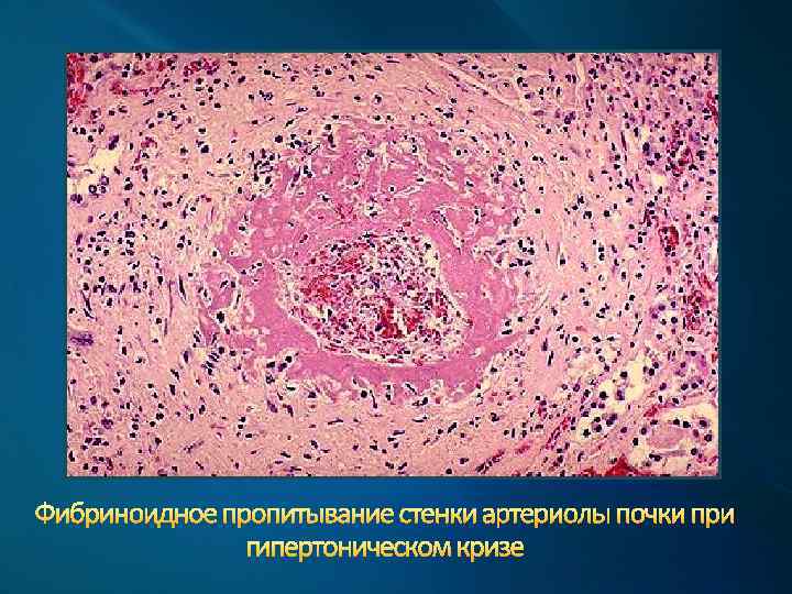 Фибриноидное пропитывание стенки артериолы почки при гипертоническом кризе 