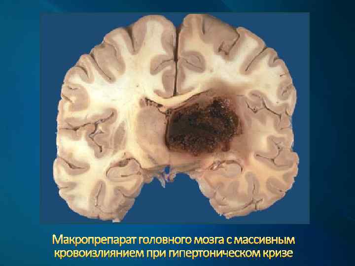 Макропрепарат головного мозга с массивным кровоизлиянием при гипертоническом кризе 
