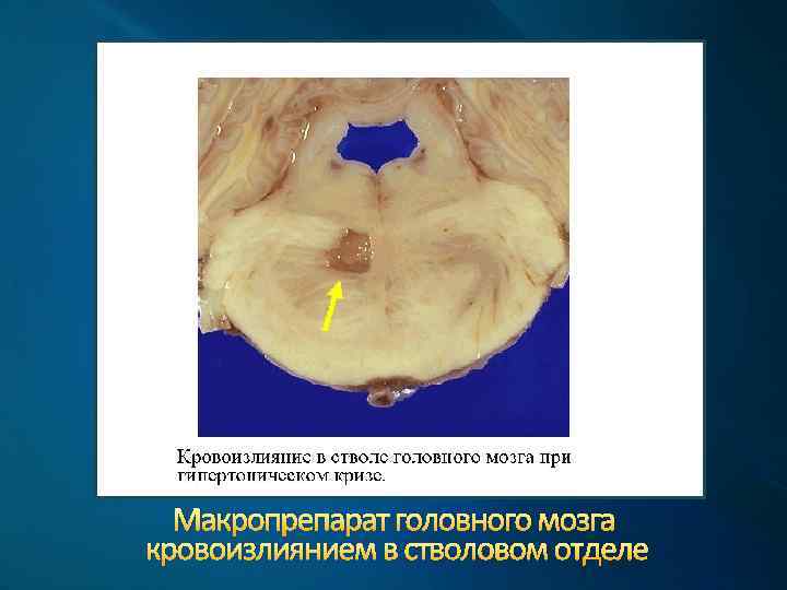 Макропрепарат головного мозга кровоизлиянием в стволовом отделе 