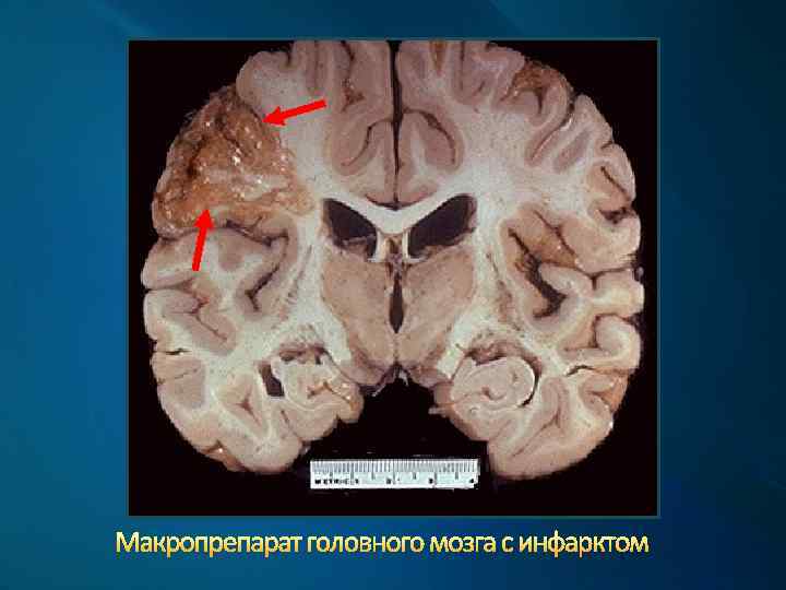 Макропрепарат головного мозга с инфарктом 