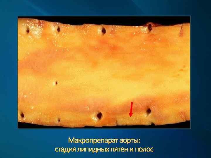 Макропрепарат аорты: стадия липидных пятен и полос 