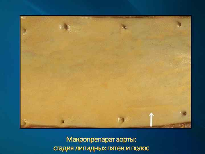 Макропрепарат аорты: стадия липидных пятен и полос 
