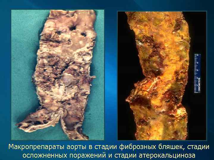 Макропрепараты аорты в стадии фиброзных бляшек, стадии осложненных поражений и стадии атерокальциноза 