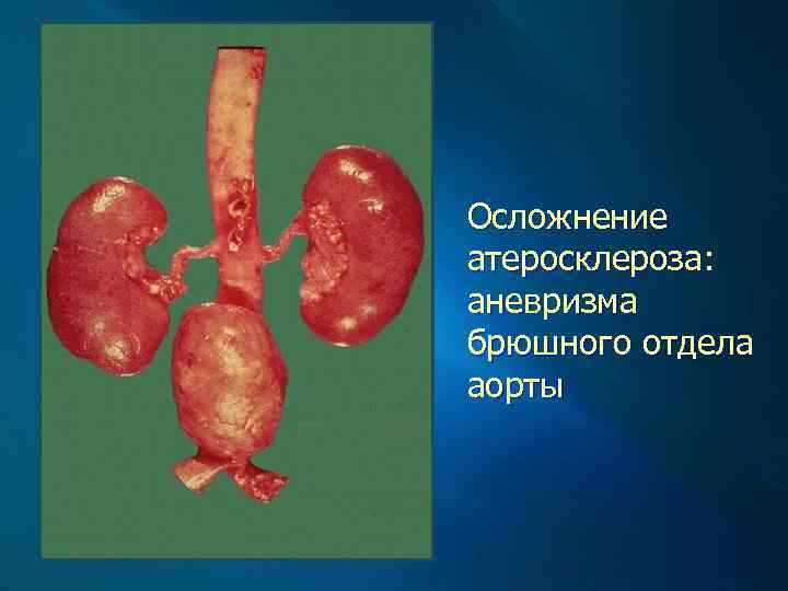 Осложнение атеросклероза: аневризма брюшного отдела аорты 