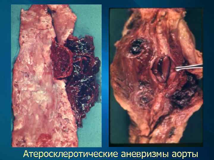 Атеросклеротические аневризмы аорты 