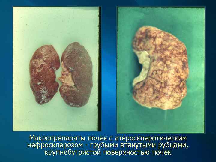 Макропрепараты почек с атеросклеротическим нефросклерозом - грубыми втянутыми рубцами, крупнобугристой поверхностью почек 