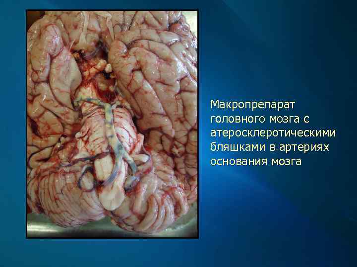 Макропрепарат головного мозга с атеросклеротическими бляшками в артериях основания мозга 