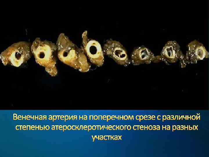 Венечная артерия на поперечном срезе с различной степенью атеросклеротического стеноза на разных участках 