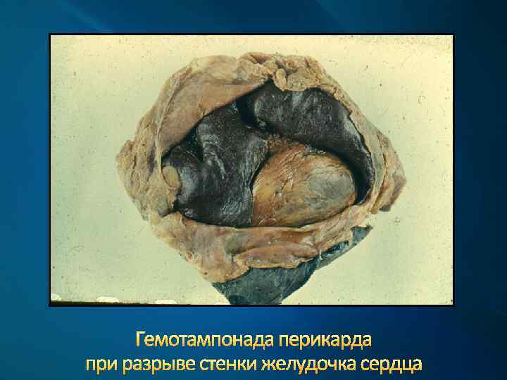 Гемотампонада перикарда при разрыве стенки желудочка сердца 