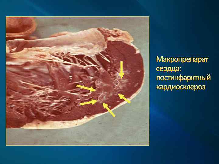 Макропрепарат сердца: постинфарктный кардиосклероз 