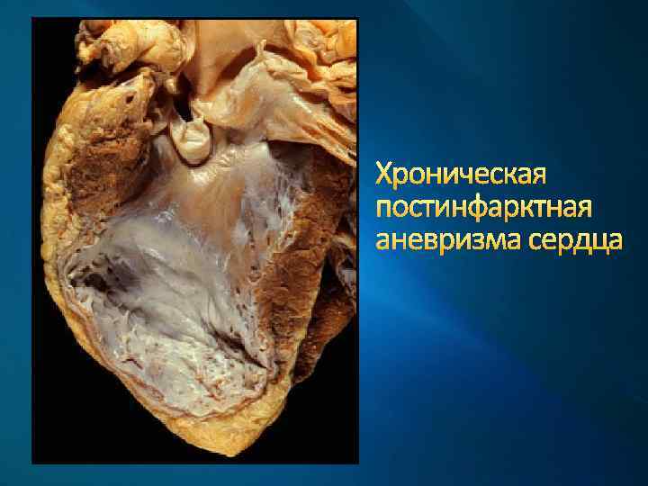 Хроническая постинфарктная аневризма сердца 
