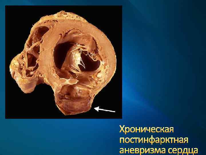 Хроническая постинфарктная аневризма сердца 