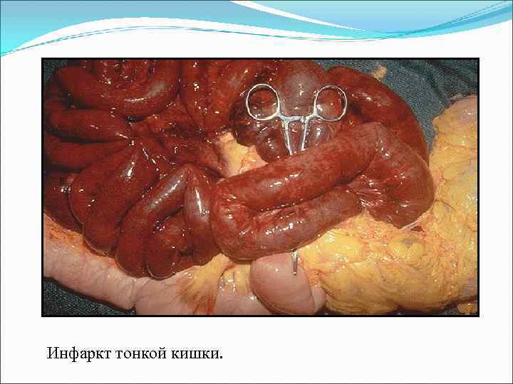 Инфаркт тонкой кишки. 