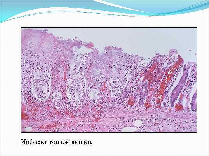 Инфаркт тонкой кишки. 
