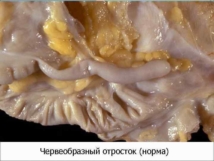 Червеобразный отросток (норма) 