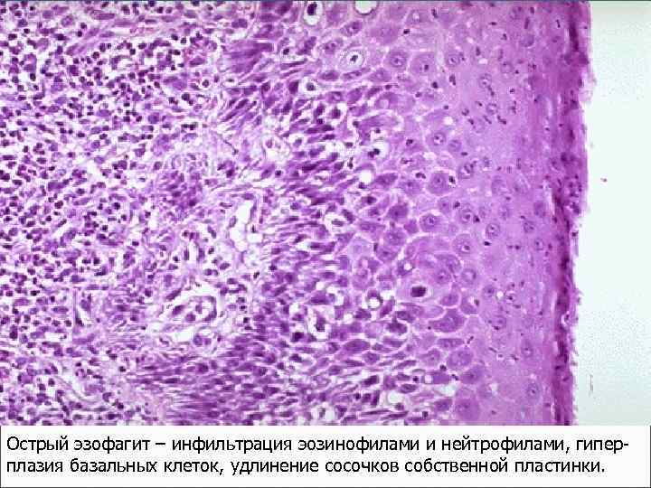 Острый эзофагит – инфильтрация эозинофилами и нейтрофилами, гиперплазия базальных клеток, удлинение сосочков собственной пластинки.