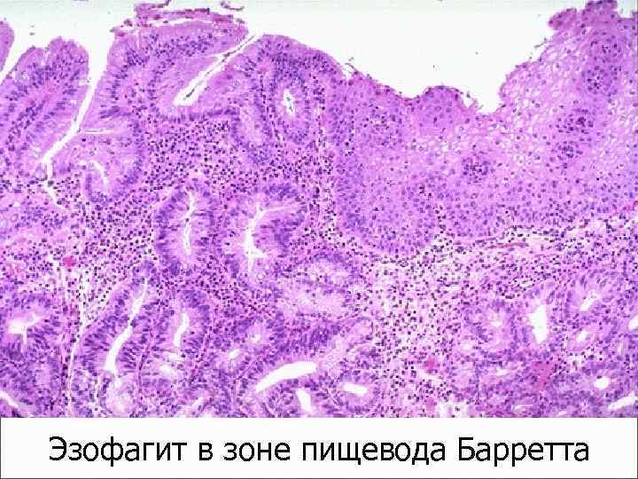 Эзофагит в зоне пищевода Барретта 