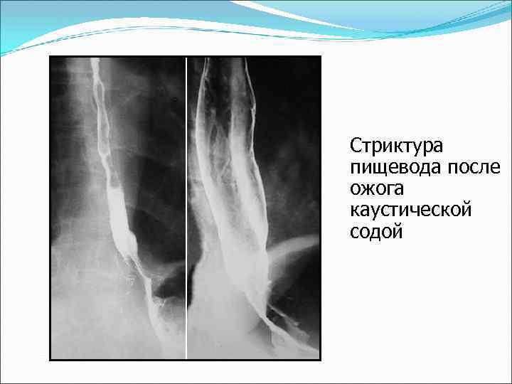 Химический ожог ротоглотки пищевода и желудка