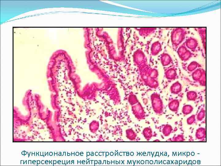 Функциональное расстройство желудка, микро - гиперсекреция нейтральных мукополисахаридов 